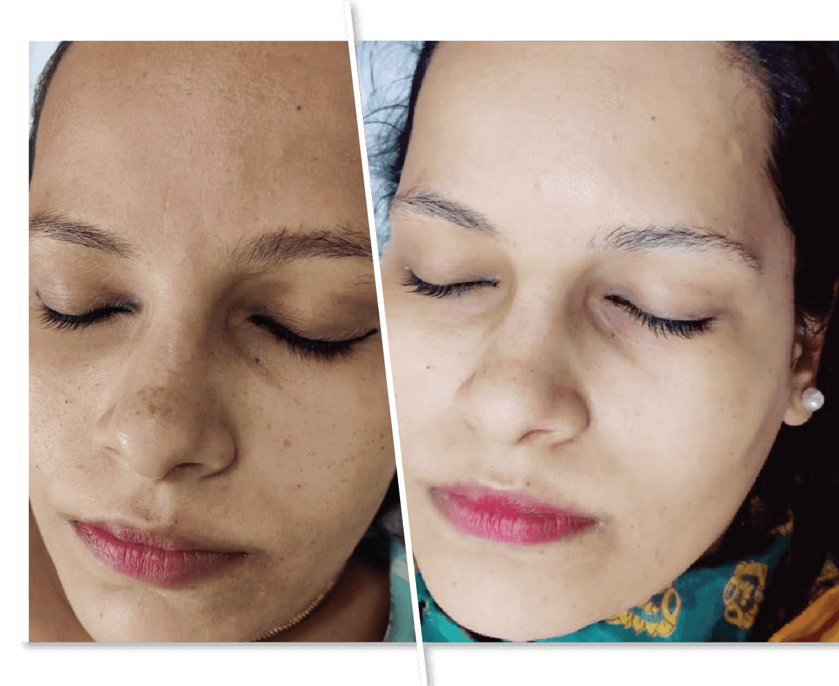 Skin Polishing Before and After Photo